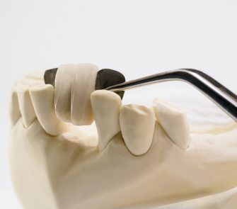 Closeup / Dental maryland bridge / Crown and bridge equipment and model express fix restoration.