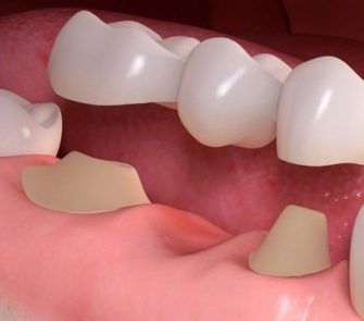 dental-bridges-in-cotswolds-gloucestershire2x
