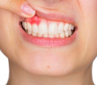 knowing-gum-disease-better